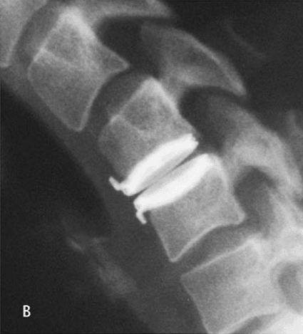 Image: Postoperative radiograph of BRYAN cervical disk (Photo courtesy of Indiana Spine Group). Image: Postoperative radiograph of BRYAN cervical disk (Photo courtesy of Indiana Spine Group).